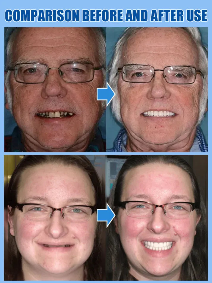 Functional Complete Dentures